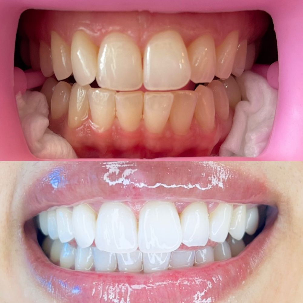 ULTRA CHIC WHITENING Updated August 2024 Katy, Texas Teeth