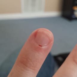 This is where they cut my cuticle and tried to cover it up This is where they cut my cuticle and tried to cover it up