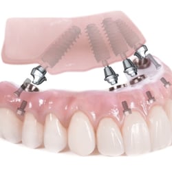 Implantation Dental Center - Dental implants