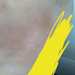 Blooming Nails & Spa - Burn on the top of my foot