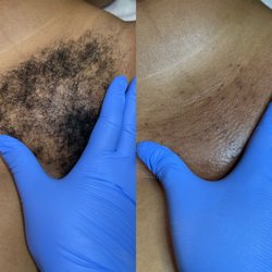 Bare Skin By Liz - Brazilian Wax Before and After.