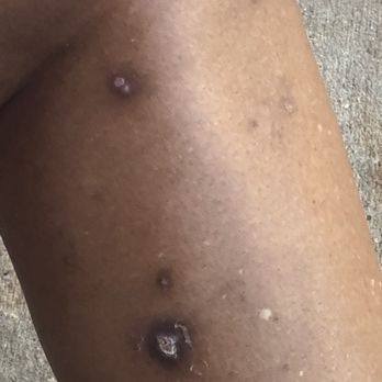Unique Dermatology - The right calf - Dermatologists Near Me - Houston, Texas Unique Dermatology - The right calf - Dermatologists Near Me - Houston, Texas