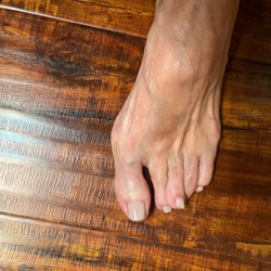 Tallahassee Orthopedic Clinic - Ruined foot