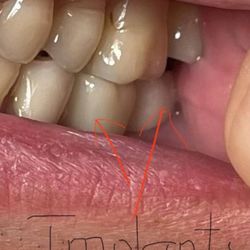Timothy Thoai Nguyen, DDS - The lower left implant is not touching the higher left tooth.