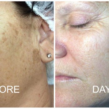 Village Spa - Sunspot removal - Day Spas Near Me - Brandon, Vermont