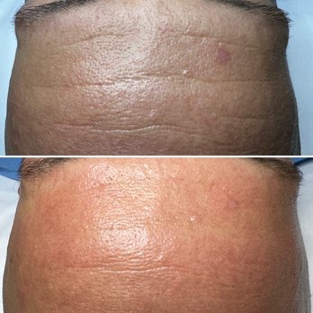 Skin Deep Laser Spa - After only ONE Microneedling treatment, lines are gone! - Laser Hair Removal Near Me - Strongsville, Ohio Skin Deep Laser Spa - After only ONE Microneedling treatment, lines are gone! - Laser Hair Removal Near Me - Strongsville, Ohio