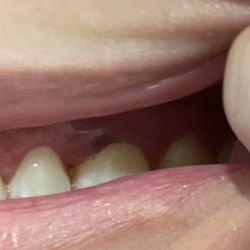 Amazing Smile Dental - Swollen gum from aggressive cleaning.