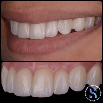 Concierge Smile Boutique - Side view of Smile Rejuvenation with only 4 veneers.
You don't always need to veneer 10-12 teeth to get stunning results. - General Dentistry Near Me - Culver City, California Concierge Smile Boutique - Side view of Smile Rejuvenation with only 4 veneers.
You don't always need to veneer 10-12 teeth to get stunning results. - General Dentistry Near Me - Culver City, California