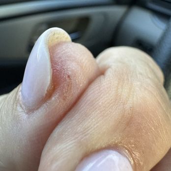 Kasa Nails - The slice in my thumb that she glued back together - Nail Salons Near Me - Alamo, California