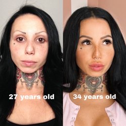 Marcel F Daniels, MD FACS FICS - Linda Tran's work- Botox and Fillers