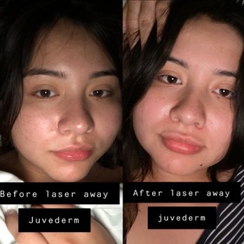 LaserAway - Laser Hair Removal Near Me - Temecula, California