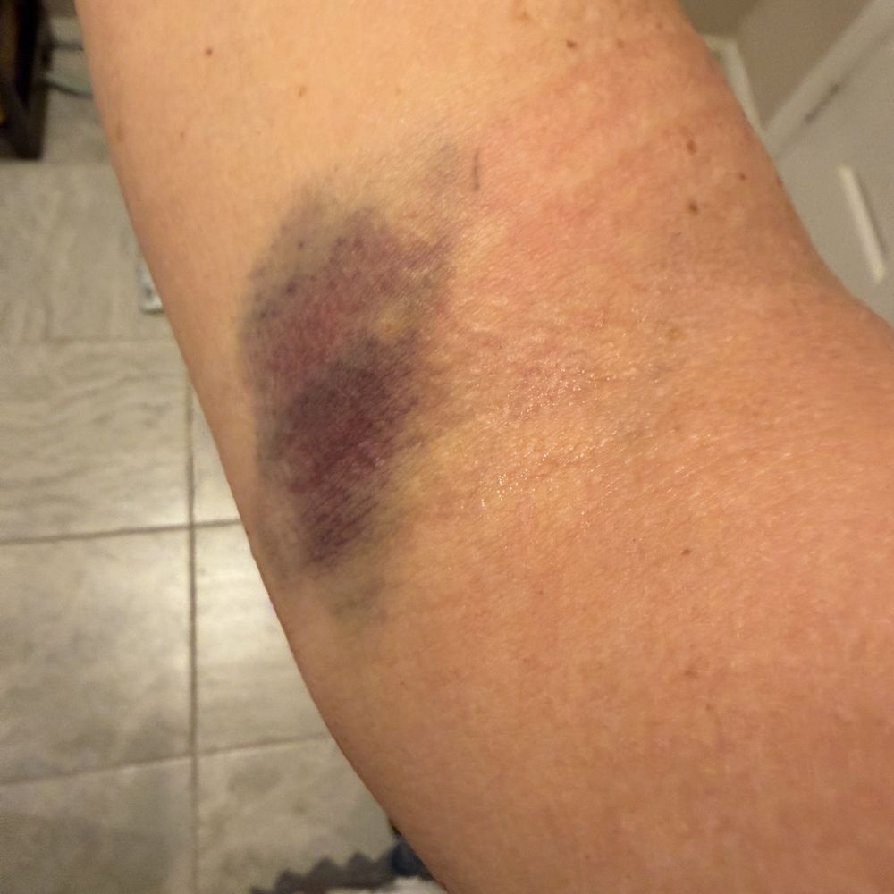 Iv experience Iv experience