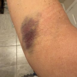 Iv experience Iv experience