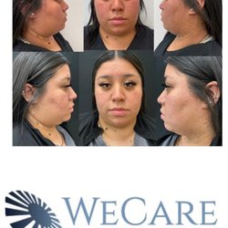 WeCare Eyes and Skin - Laser genesis is a no-downtime, no-pain laser treatment that helps even out skin tone and gives you a gorgeous glow. Post 1 treatment.