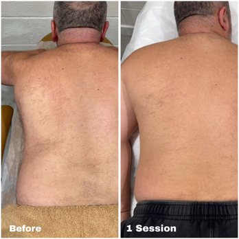 Gray Laser - Results after only 1 Session! - Laser Hair Removal Near Me - Glendale, California Gray Laser - Results after only 1 Session! - Laser Hair Removal Near Me - Glendale, California
