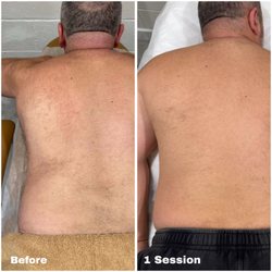 Gray Laser - Results after only 1 Session!