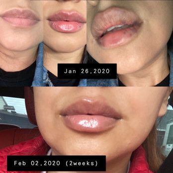 Flawless Skin Center - Nurse Syuzanna. 2 week progress. - Laser Hair Removal Near Me - Burbank, California Flawless Skin Center - Nurse Syuzanna. 2 week progress. - Laser Hair Removal Near Me - Burbank, California