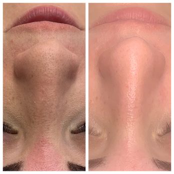 The Astral Studio - Before and after - Skin Care Near Me - Rochester, New York