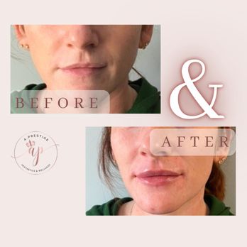 A Prestige Aesthetics and Wellness - Lip filler - Medical Spas Near Me - Franklin, Tennessee A Prestige Aesthetics and Wellness - Lip filler - Medical Spas Near Me - Franklin, Tennessee