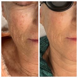Laser Options By Jen - Results 4 weeks after 1 IPL Photo-facial