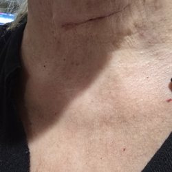 Advanced Spine Care - Kushagra Verma, MD - 2 1/2 weeks post op