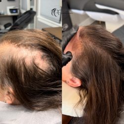 Fountain Of Youth - Berkeley SMP creates a natural, youthful hairline for women.