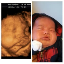 Baby Pix 3D Ultrasound