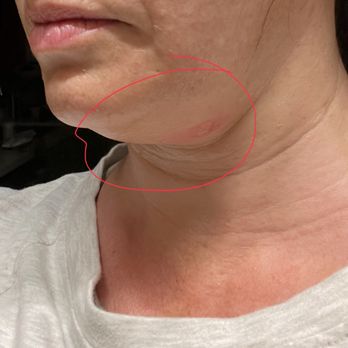 RefinedMD - Burns - Medical Spas Near Me - Los Gatos, California