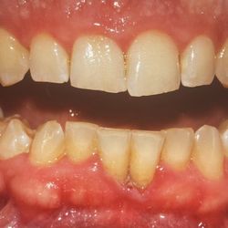 Fine Dentistry of Downtown Orlando - My Before