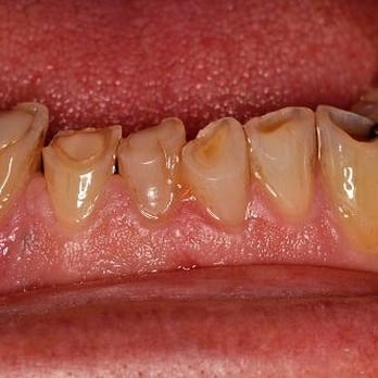 Thomas F Barton, DDS PC - Patient 1 - Before - General Dentistry Near Me - Kansas City, Missouri Thomas F Barton, DDS PC - Patient 1 - Before - General Dentistry Near Me - Kansas City, Missouri