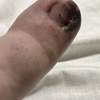 OV Posh Nail Spa - Infection from no sterile tools - Nail Salons Near Me - Oro Valley, Arizona OV Posh Nail Spa - Infection from no sterile tools - Nail Salons Near Me - Oro Valley, Arizona
