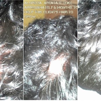 Hairoots Hair Replacement - It took approximately 6 months for the clients hair to grow. Client had Alopecia Areata, an autoimmune disorder. - Hair Loss Centers Near Me - Brea, California Hairoots Hair Replacement - It took approximately 6 months for the clients hair to grow. Client had Alopecia Areata, an autoimmune disorder. - Hair Loss Centers Near Me - Brea, California