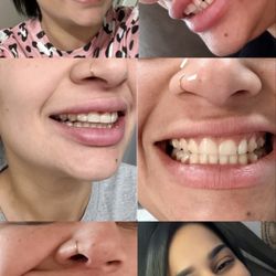 Fort Smith Smiles - Invisaling treatment and Veneers