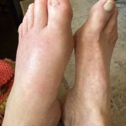 Walmart Pharmacy - Gout on the left