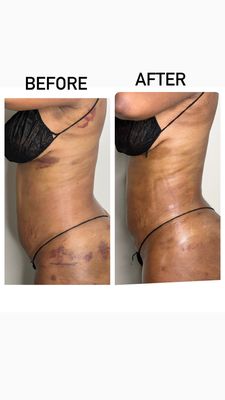 Post Op - A post-operative (post-op) massage is a specialized therapeutic massage designed to support recovery after surgery. It focuses on improving circulation, reducing swelling, minimizing scar tissue formation, and enhancing overall healing. Techniques used in post-op massage are gentle and tailored to the individual's specific surgical procedure and recovery needs. Benefits of post-op massage include:
Reduced Swelling: Helps decrease fluid buildup and inflammation.
Scar Tissue Management: Promotes softer and more flexible scar tissue formation.
Improved Circulation: Enhances blood flow to the surgical area, aiding in tissue repair.
Pain Relief: Alleviates discomfort and reduces muscle tension.
Enhanced Mobility: Helps restore range of motion and prevents stiffness.
Relaxation: Reduces stress and promotes overall well-being during the recovery process. Post Op - A post-operative (post-op) massage is a specialized therapeutic massage designed to support recovery after surgery. It focuses on improving circulation, reducing swelling, minimizing scar tissue formation, and enhancing overall healing. Techniques used in post-op massage are gentle and tailored to the individual's specific surgical procedure and recovery needs. Benefits of post-op massage include:
Reduced Swelling: Helps decrease fluid buildup and inflammation.
Scar Tissue Management: Promotes softer and more flexible scar tissue formation.
Improved Circulation: Enhances blood flow to the surgical area, aiding in tissue repair.
Pain Relief: Alleviates discomfort and reduces muscle tension.
Enhanced Mobility: Helps restore range of motion and prevents stiffness.
Relaxation: Reduces stress and promotes overall well-being during the recovery process.