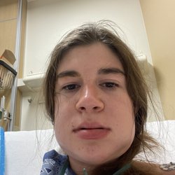 Robert J Relle, DDS - ~9 hours post op. This was my "wtf have I done to my face" moment lol