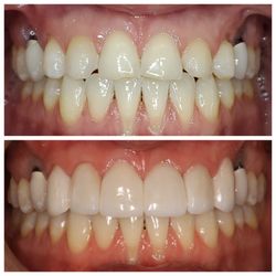 Pacific Manor Dental - Before and after. Another happy patient