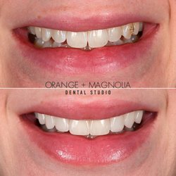 Orange and Magnolia Dental Studio - 8 porcelain veneers by Dr. Joyce Kahng, cosmetic dentist in Orange County veneers to show more teeth