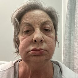 Israel Salomon, DDS PA - That 2nd surgery