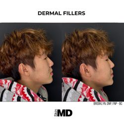 Dermal Fillers