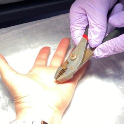 Logan InstaCare - Rusty pliers used to remove staple from hand.