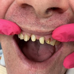 Lakeside Smiles - A month ago I walked in with this mouth.  You would never see me smile.  I had no confidence.  That was Then!!!!!!!