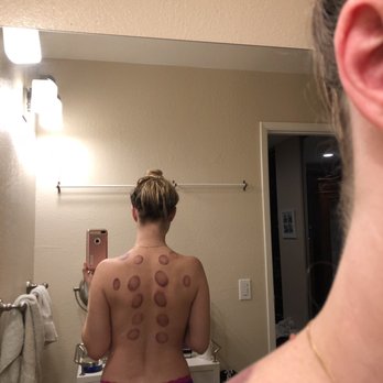 Melinda Phoenix - Cupping is incredible for my pain. - Acupuncture Near Me