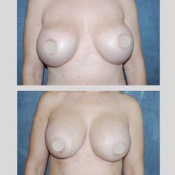 David Godat, MD - Internal Bra, 1 Month Post Op