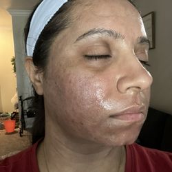 Ultimate Image MedSpa - After the E-Matrix session.