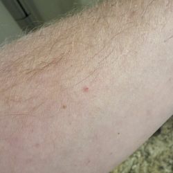 MD Now Urgent Care - The red dot below the freckle was the site done by the MA. No wheal all done subcutaneously and thus incorrectly.