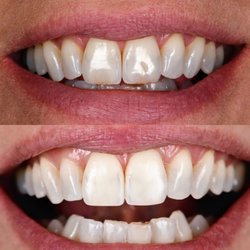 Dental bleaching and bonding a few upper teeth can go a long way