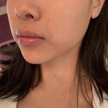 NU Med Spa - After! Obviously still some needle spots and bruising but such an amazing difference. - Medical Spas Near Me - Los Angeles, California NU Med Spa - After! Obviously still some needle spots and bruising but such an amazing difference. - Medical Spas Near Me - Los Angeles, California