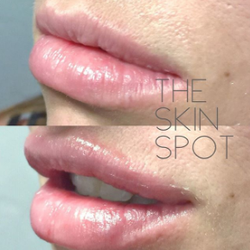 The Skin Spot MedSpa - DenverskinspotEnhancing the shape creating a beautiful Cupid's bow while looking natural.. #lips#natural#lipinjections#denver#cupidsbow#