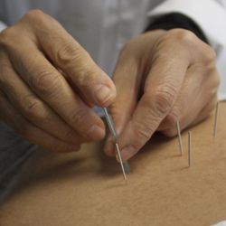 Ace Acupuncture